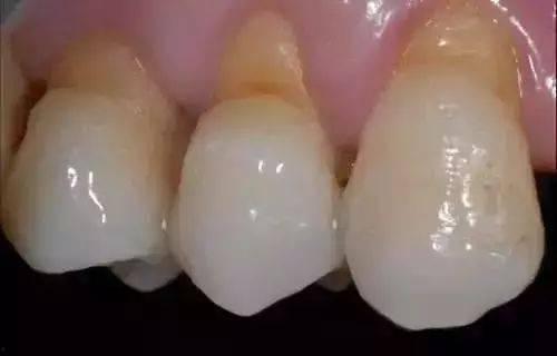 成人门牙根形状图解视频,揭秘牙齿解剖奥秘