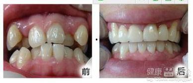 成人门牙根形状图解视频,揭秘牙齿解剖奥秘